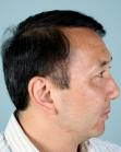 After Hair Transplant&nbsp;Front